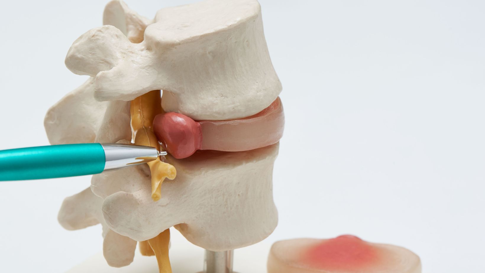 Diagnosing Vacuum What Is The Treatment For Vacuum Disc Phenomenon